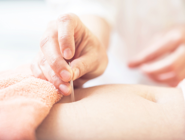 acupuncture