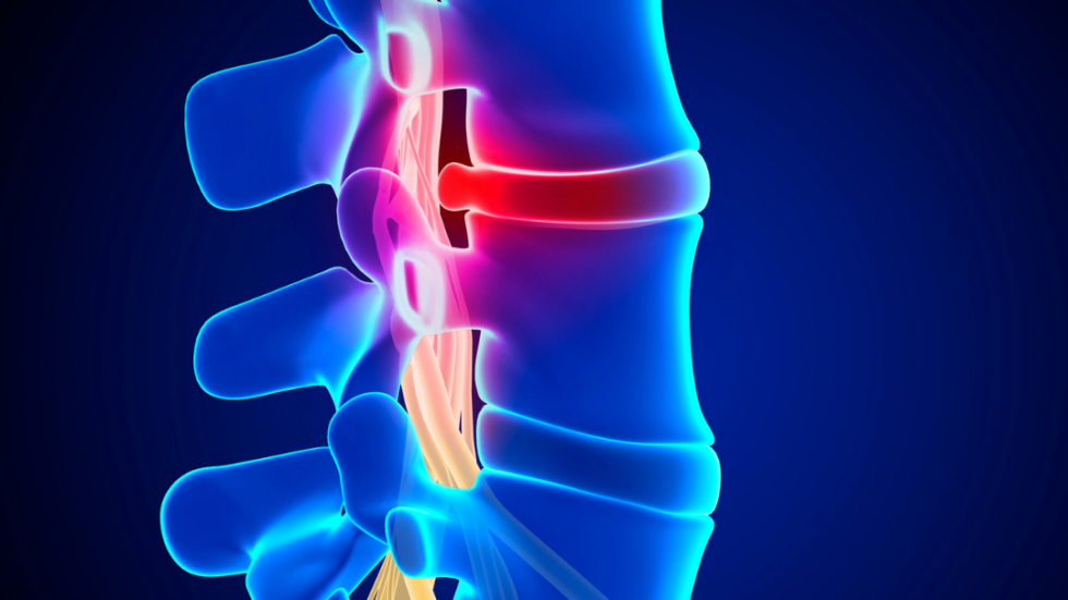Causes and Symptoms of Slipped Disc 