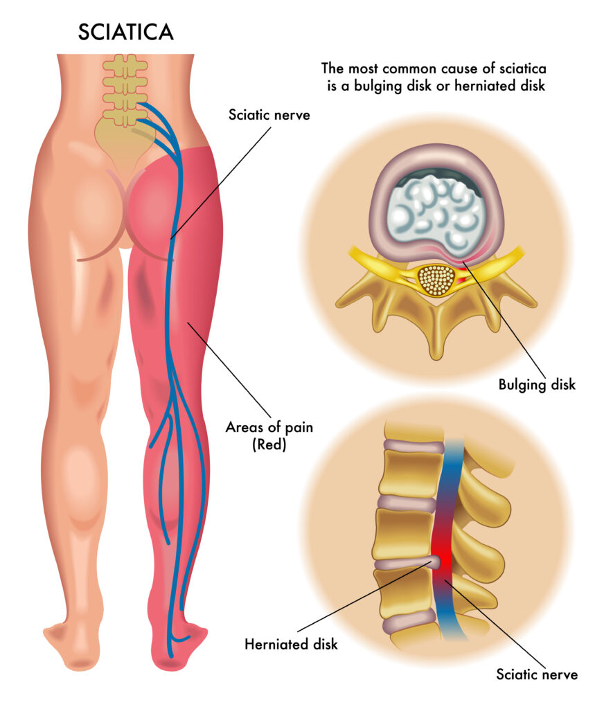 Nerve Compression