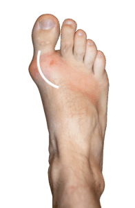 Foot-Pain-Gout Foot Pain Gout