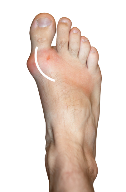 Foot-Pain-Gout Foot Pain Gout