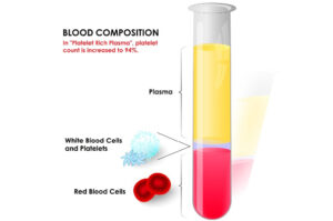 Platelet Rich Plasma Prolotherapy Coreflex Injections