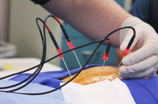 Pulsed Radiofrequency Pulsed Radiofrequency