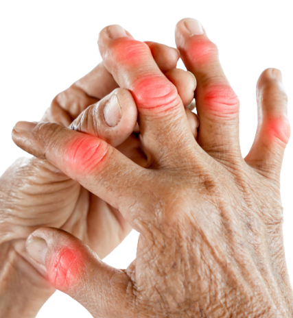 Rheumatoid-Arthritis Rheumatoid Arthritis