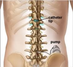 intrathechal-pump-implant_edited Coreflex Injections