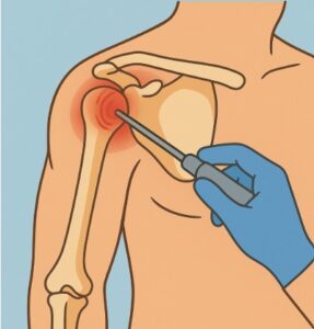 shoulder pain specialist