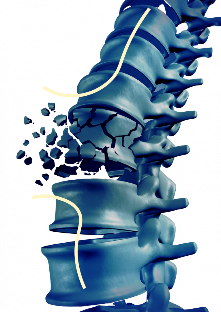 Osteoporosis Osteoporosis