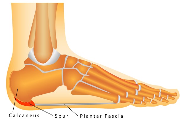Bone Spur vs Plantar Fasciitis: What Is Really Causing Your Heel Pain?