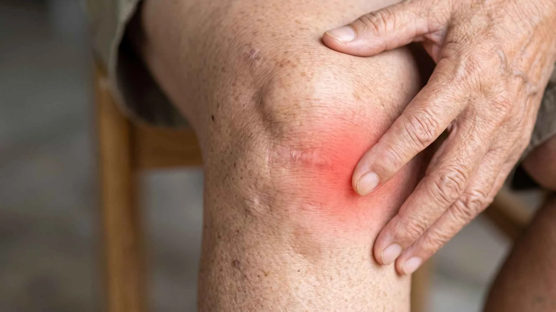 My Knee Osteoarthritis Is Getting Worse — What Are My Options?